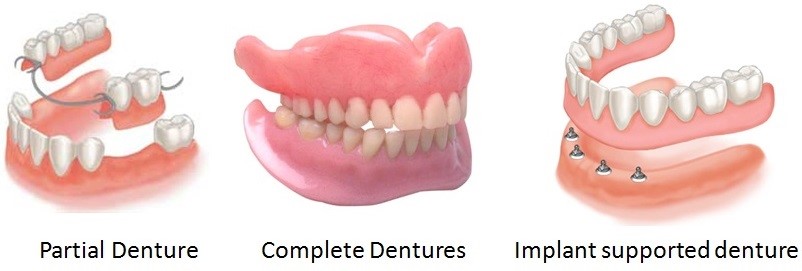 New Dentures 2018 Yelm WA 98597